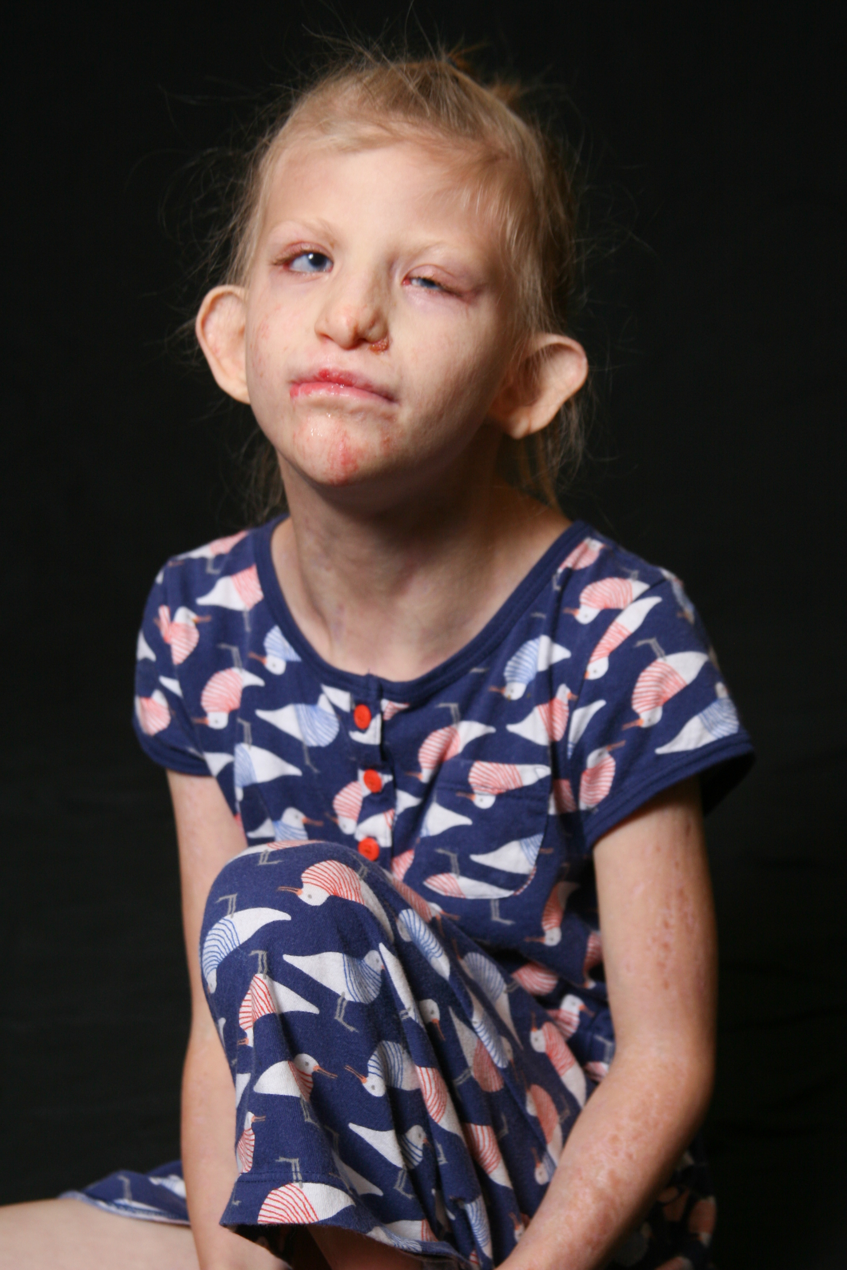Dylan, Goltz syndrome