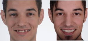Young Adult Before And After Implants