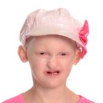 A girl affected by AEC syndrome is missing teeth.