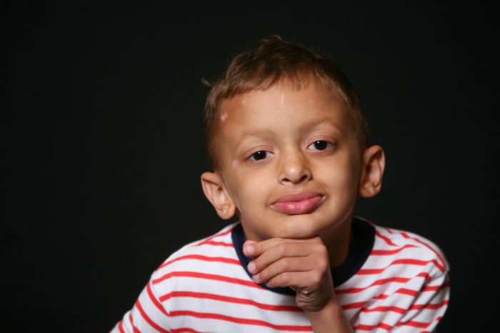 Boy With HED3