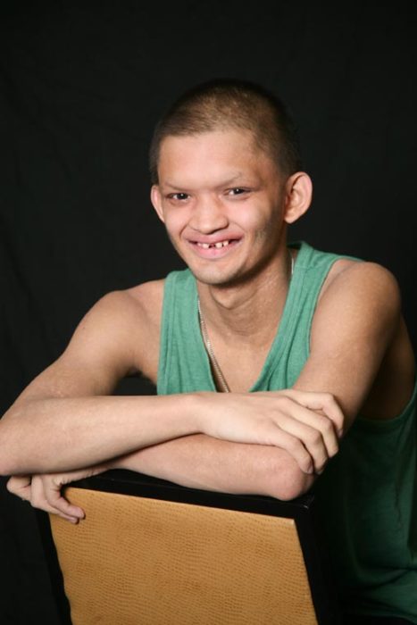 Teen With XLHED