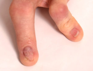abnormal nails in EEC syndrome