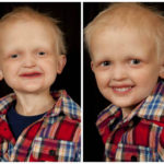 A boy with HED shows his smile before and after getting dentures. 
