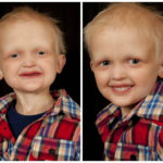 A boy with HED shows his smile before and after getting dentures.
