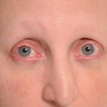 A woman affected by AEC syndrome is missing eyelashes.