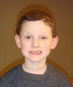 Aidan smiling with his lower dentures.