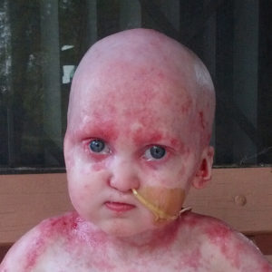 Baby girl with skin erosion