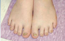 Clouston Toenails