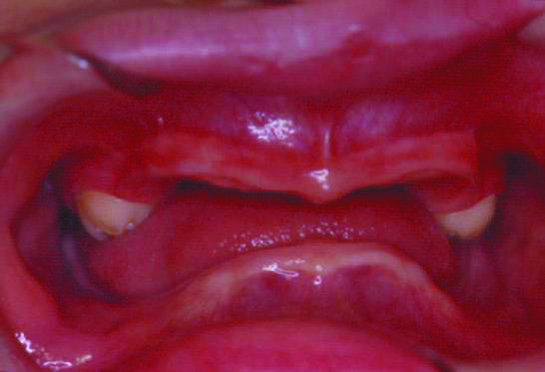 Missing Teeth
