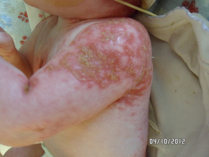 This is the picture of a baby with AEC syndrome's torso, arm and shoulder. There is skin erosion on the upper arm, shoulder and under arm.