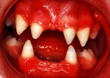 Abnormal Teeth Eruption