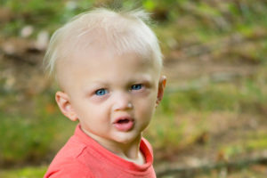 Toddler with Hypohidrotic ectodermal dysplasia has classic symptoms of sparse hair, missing teeth and inability to perspire.