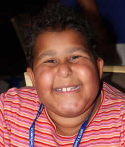 Girl affected by trichorhinophalangeal syndrome type 1 (TRPS1)