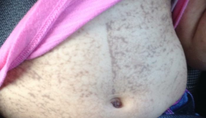 incontinentia pigmenti stages - stage 3