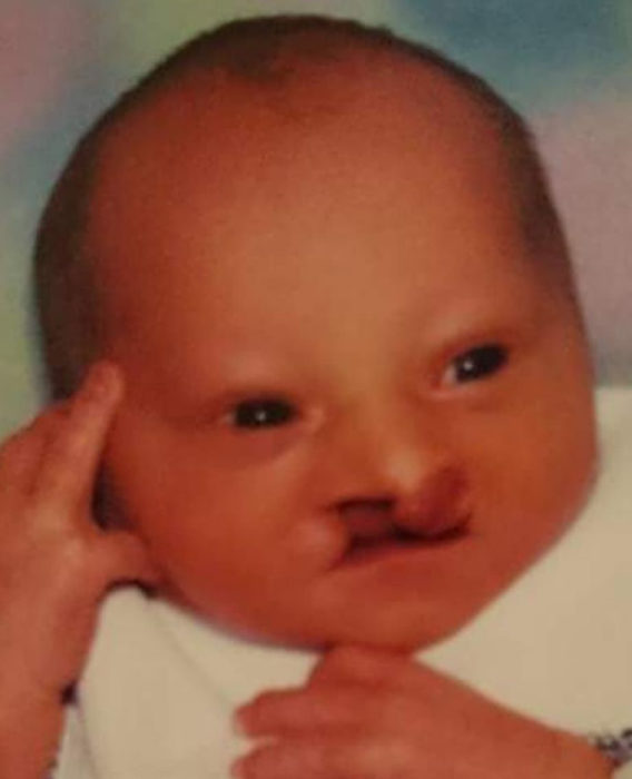 A baby boy affected by AEC syndrome has a bilateral cleft lip.