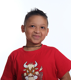 Child with Ectodermal Dysplasia