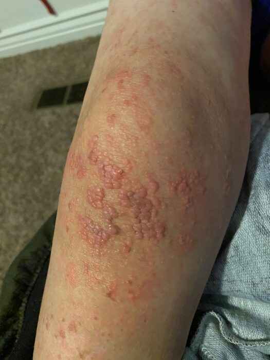 Papillomas in Goltz syndrome appear on the knee of a child affected by the condition.