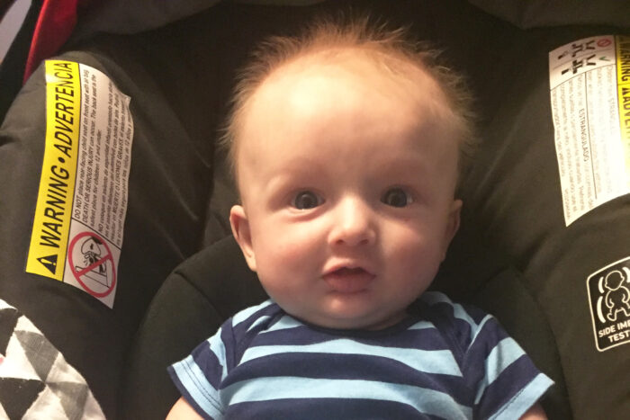 A baby boy affected by hypohidrotic ectodermal dysplasia is smiling. He has sparse blonde hair.