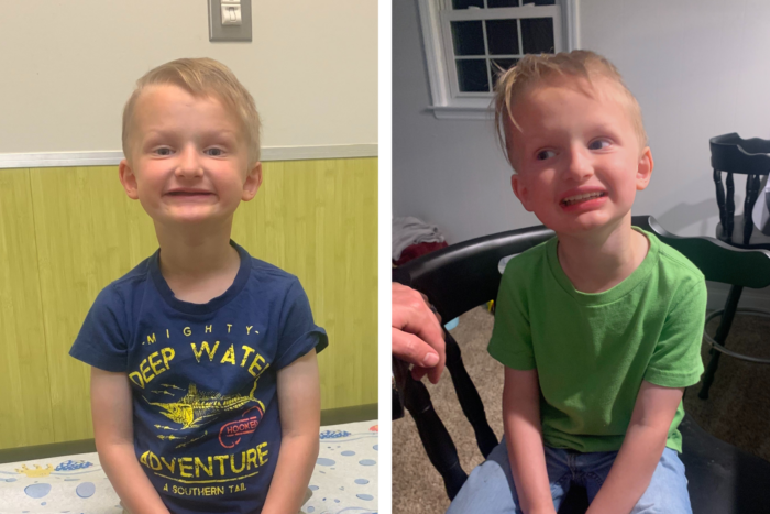 A toddler boy with XLHED is smiling and showing his new dentures to replace his missing teeth.