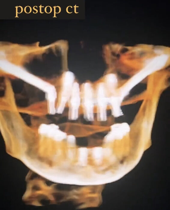 This dental x-ray shows Finlay's mouth after surgery to get dental implants. They placed implants on the top.