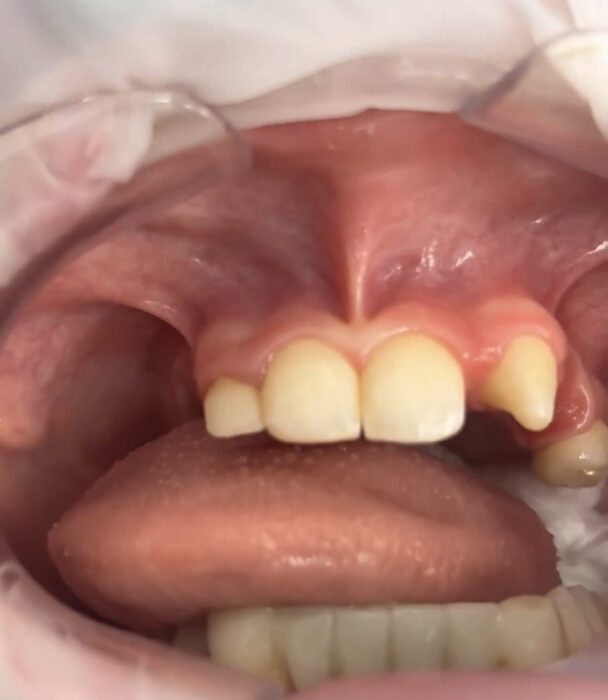This is an intra-oral photo of Finlay's mouth. It shows that she has only five teeth on top, one being conical shaped. 